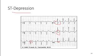 ECG 10: Ischemic Changes