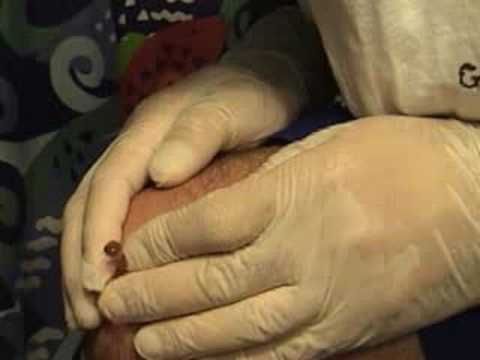 Knee Draining #2 : A must see..... - YouTube