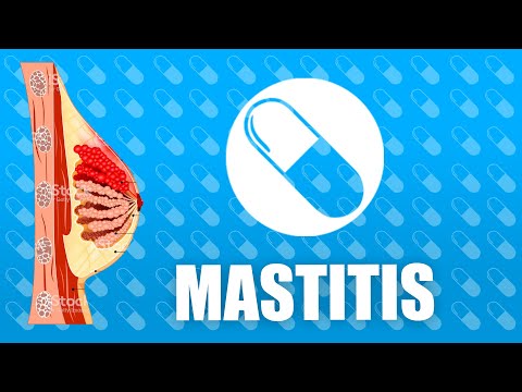 Vídeo: Mastitis - Definición Y Educación Del Paciente