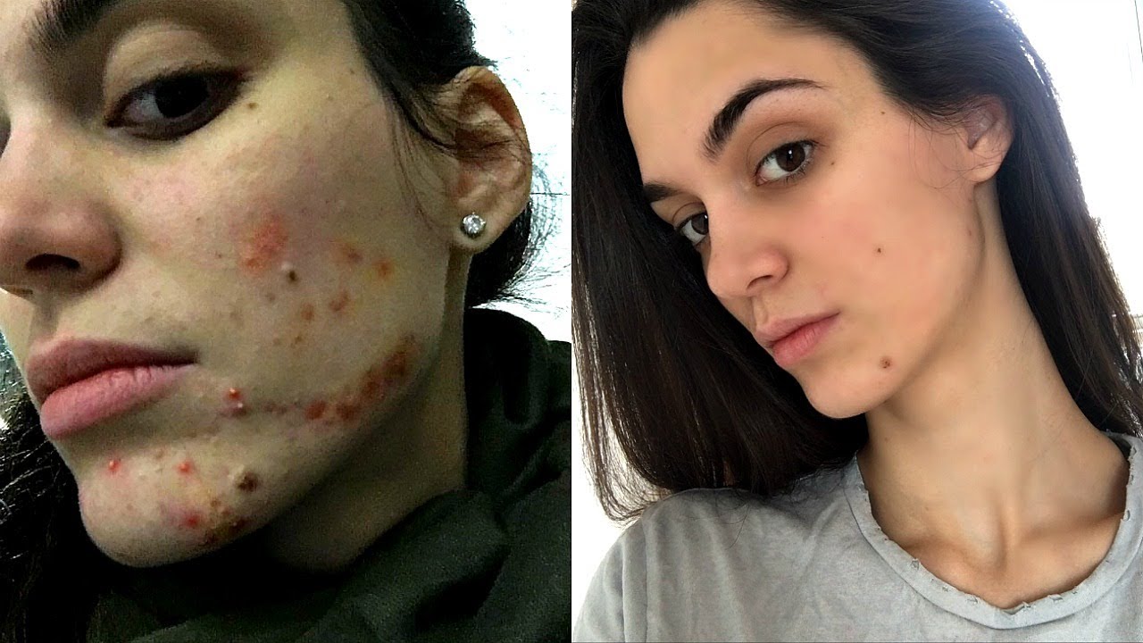 HOW I got rid of my ACNE NATURALLY in 30 days! - YouTube
