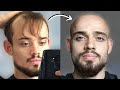 100 balding men beforeafter shaving head bald 2