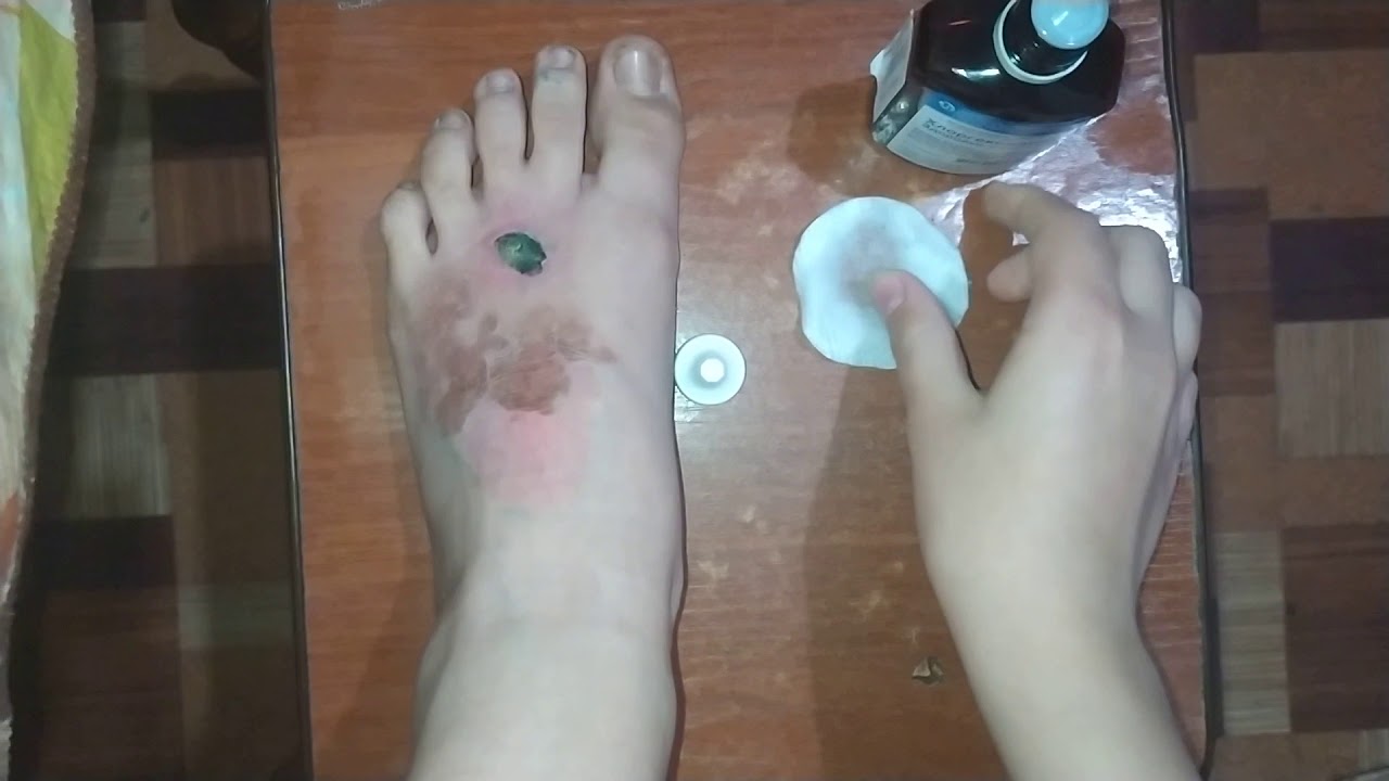 Обработка раны после ожога / P.S рана Уде стухла , после ожога прошло 3 ...