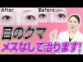 目の下のクマは手術なしで取れる!?