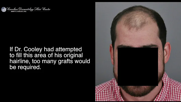 Hair Transplant Results - 3500 Grafts - FUT - Jerr...