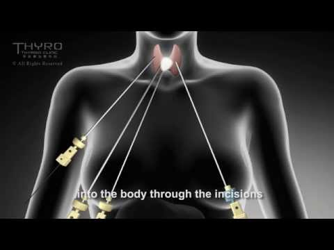 thyroidectomy invasive