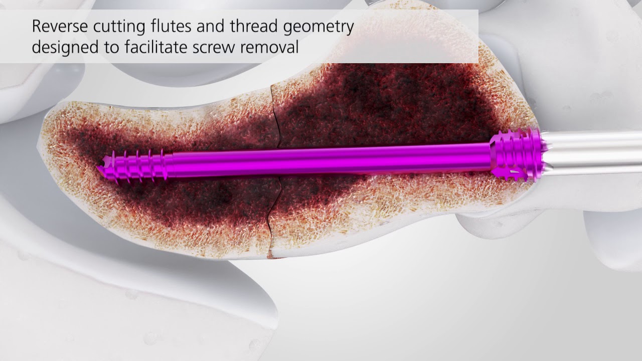 Cannulated Compression Headless Screws YouTube