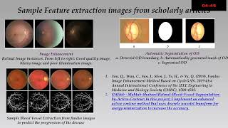 AIOS2025 GP217 T Dr Sathyan PARTHASARATHI AI and Machine Learning in Glaucoma Diagnosis Exploring