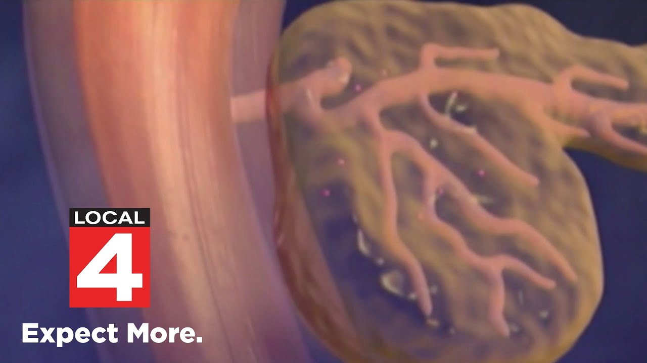 Using AI to detect pancreatic cancer