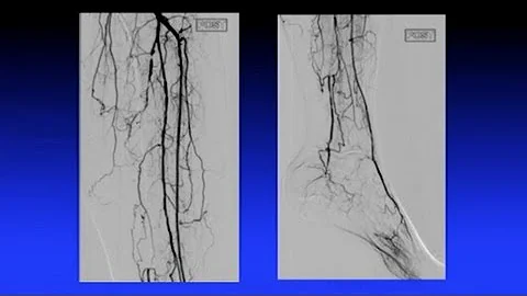Atherectomy: Options and Techniques