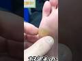 13年物の角質がこちら#サッカー #足#足裏#整体#massage#足つぼ #foot #マッサージ #美女 #絶叫#肩こり#膝痛#施術#外反母趾#sole#fitness#足ツボ #悶絶