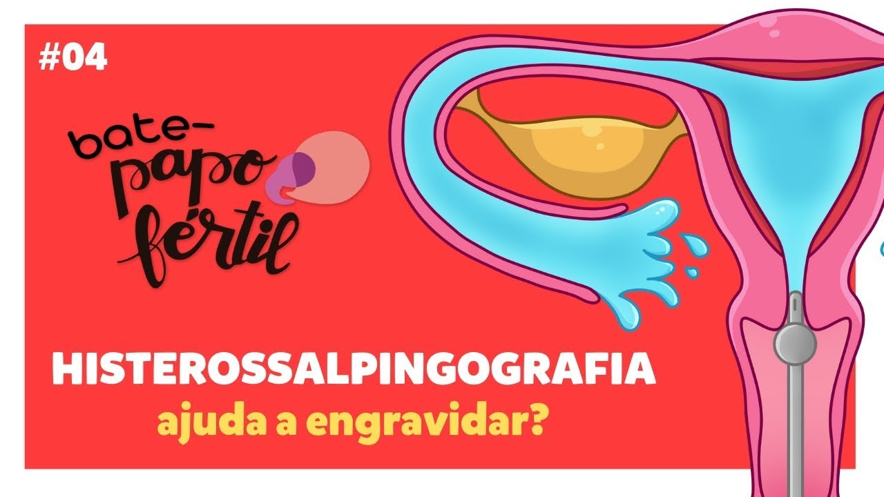 HISTEROSSALPINGOGRAFIA Ajuda a Engravidar? | BATE-PAPO FÉRTIL EP#04 ...