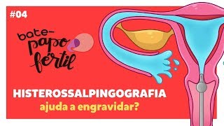 HISTEROSSALPINGOGRAFIA Ajuda a Engravidar? | BATE-PAPO FÉRTIL EP#04