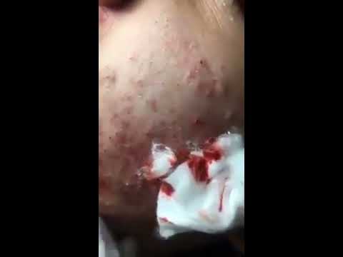 Eww ep : Gross bloody cheek acne extraction