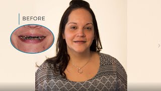 From 20 Years of Dental Destruction to a Renewed &amp; Confident Smile. Rachel&#39;s Story