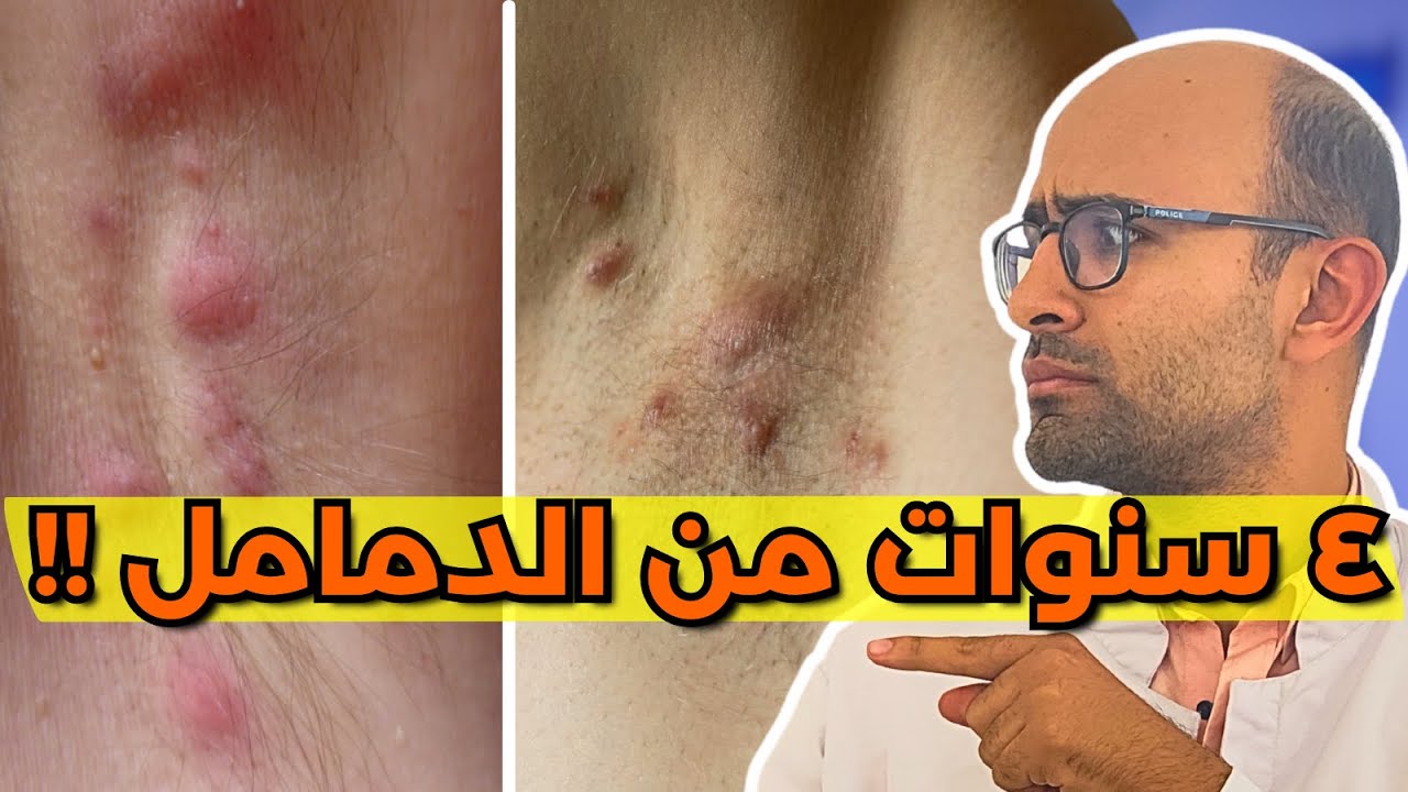 Hidradenitis Suppurativa الدمامل تحت الابط مش دمامل ؟ التهاب