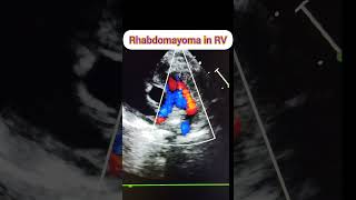 Intresting echo case#Rhabdomyoma in RV#Rhabdomyoma echo video