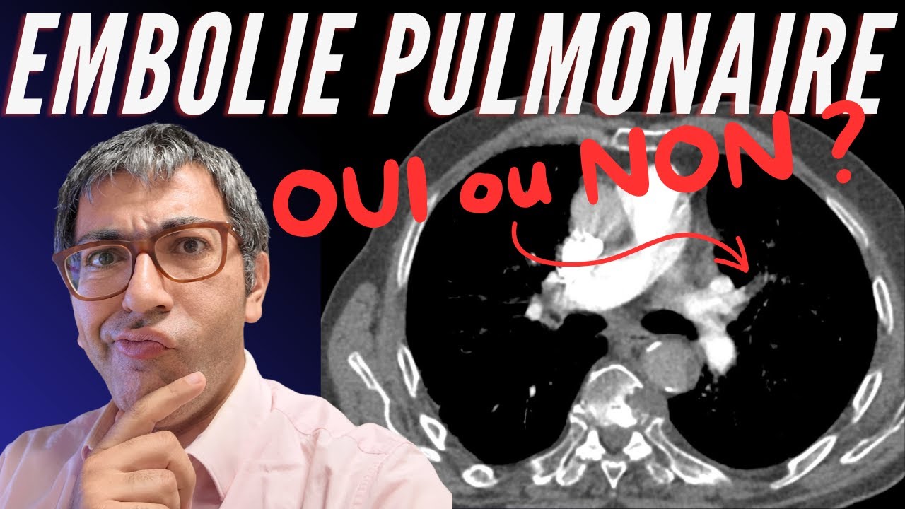 Angioscanner Pulmonaire en urgence : on valide l'EP ou pas ?