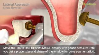 Total Solution for Sinus (Lateral approach)