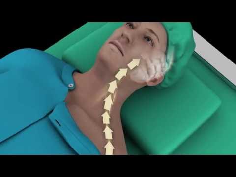Video: Occipitale Zenuwblokkering: Procedure, Voordelen En Bijwerkingen