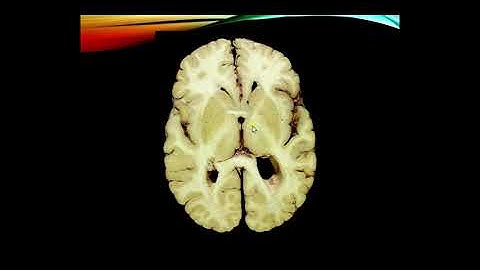 Gross Neuroanatomy, Part 2