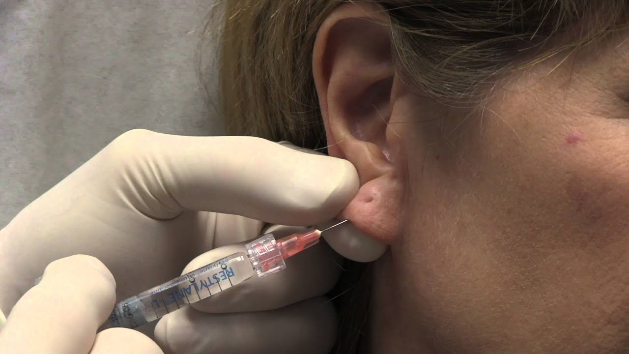 Banner for Earlobe Rejuvenation with Restylane | 858-314-9244