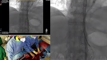 e-nside implant with total retrograde femoral approach
