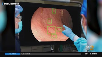 New AI helps detect potentially cancerous polyps in the colon