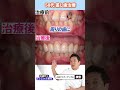 【50代の若返りセラミック】とれた差し歯をキレイに! #shorts