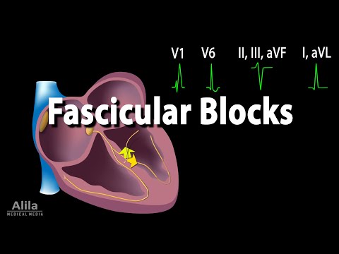 Video: Vad är ett fascikulärt block?