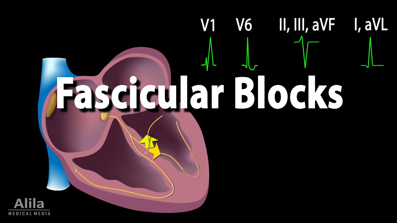 Is Bifascicular A Heart Block?