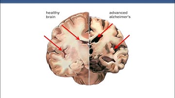 Dementia education I An introduction to brain health