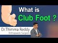 What is Club Foot| Causes of Club Foot | Club Foot in Children| Dr.Thimma Reddy | Orthopedic Surgeon