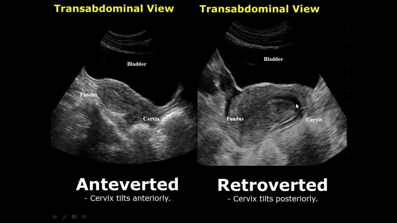 Uterine Positions In Ultrasound Anteverted/Retroverted Anteflexed