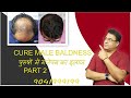Hair fall treatment  hair fall treatment for men  hair fall treatment at home  part 2