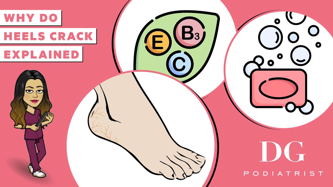 Why do heels crack? Cracked heels treatment series The Foot Scraper