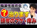 頭皮がかゆい！フケが止まらない！原因はマラセチア？今すぐやめるNG習慣！脂漏性皮膚炎の原因“ストレス/食べ物/ホルモン”全部話します