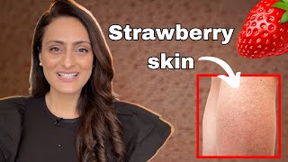 How to treat Strawberry skin | क्यूँ होता है | कैसे सही करे | त्वचा के डॉक्टर | Dr. Aanchal Panth