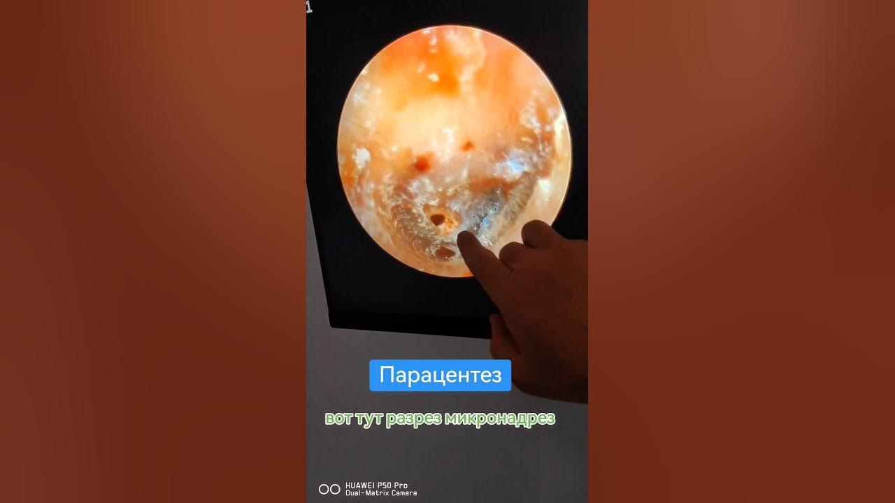Парацентез барабанной перепонки #лорврач #тугоухость #ринопластика # ...