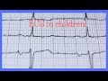 ECG in children/Pediatric ECG
