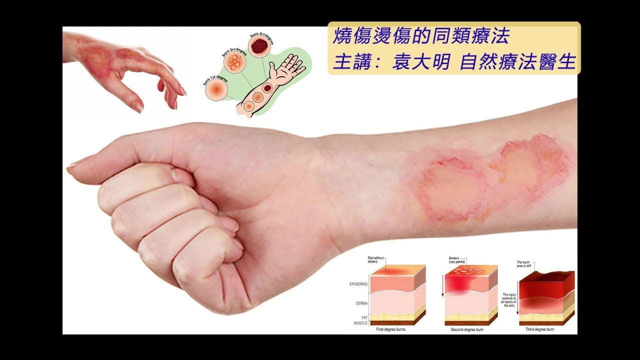 《自然療法與你》- EP660 - 燒傷燙傷的同類療法 - YouTube