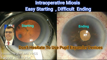 Phacoemylsificatin And Intraoperative floppy Iris Syndrome (IFIS)