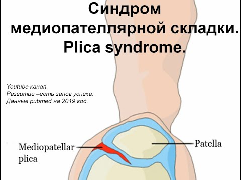 Часть 65.Синдром медиопателлярной складки.Синдром Plica. Западная литература