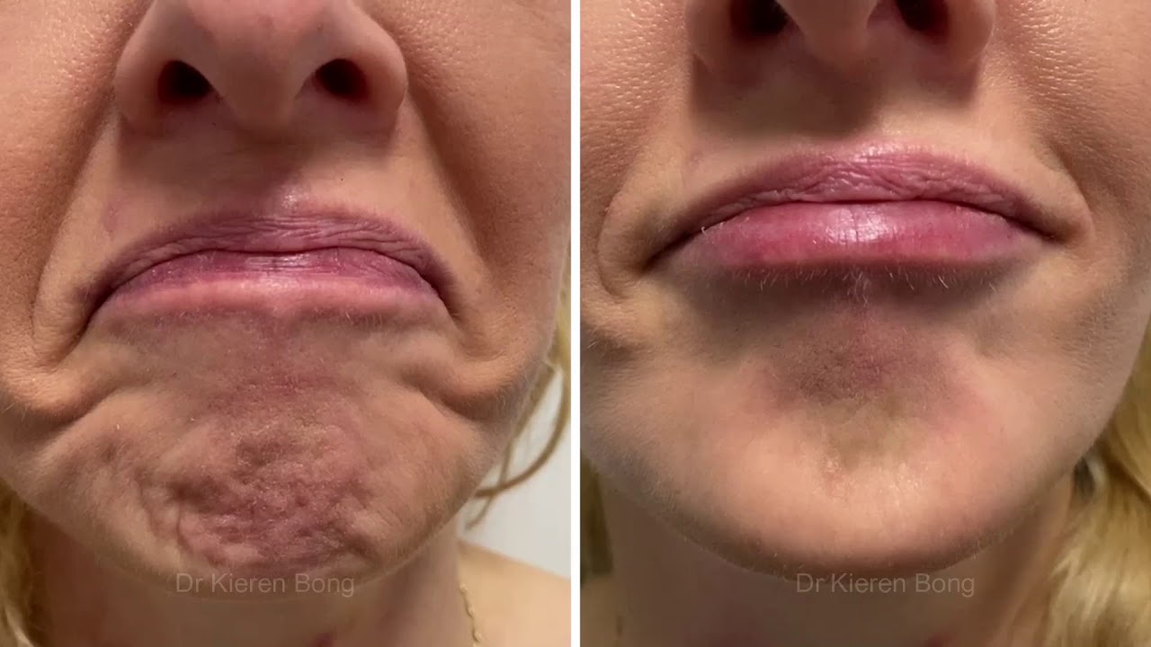 Botox Injections For Dimpled Uneven Puckered Orange Peel Chin Youtube