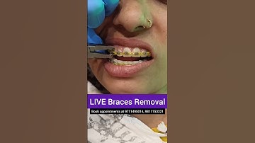LIVE Braces Removal- Debonding; Dr. Srishti Bhatia #braces #teeth