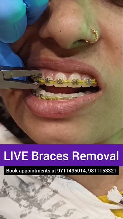 Download lagu LIVE Braces Removal- Debonding; Dr. Srishti Bhatia #braces #teeth