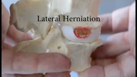 Far Lateral Herniation - Disc Model