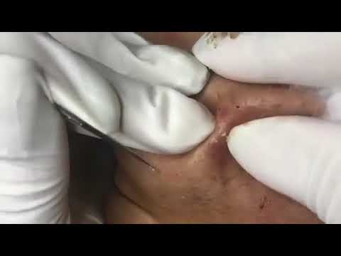 Acne, Blackheads, Pimples And Cystic Acne Removal On Face # 