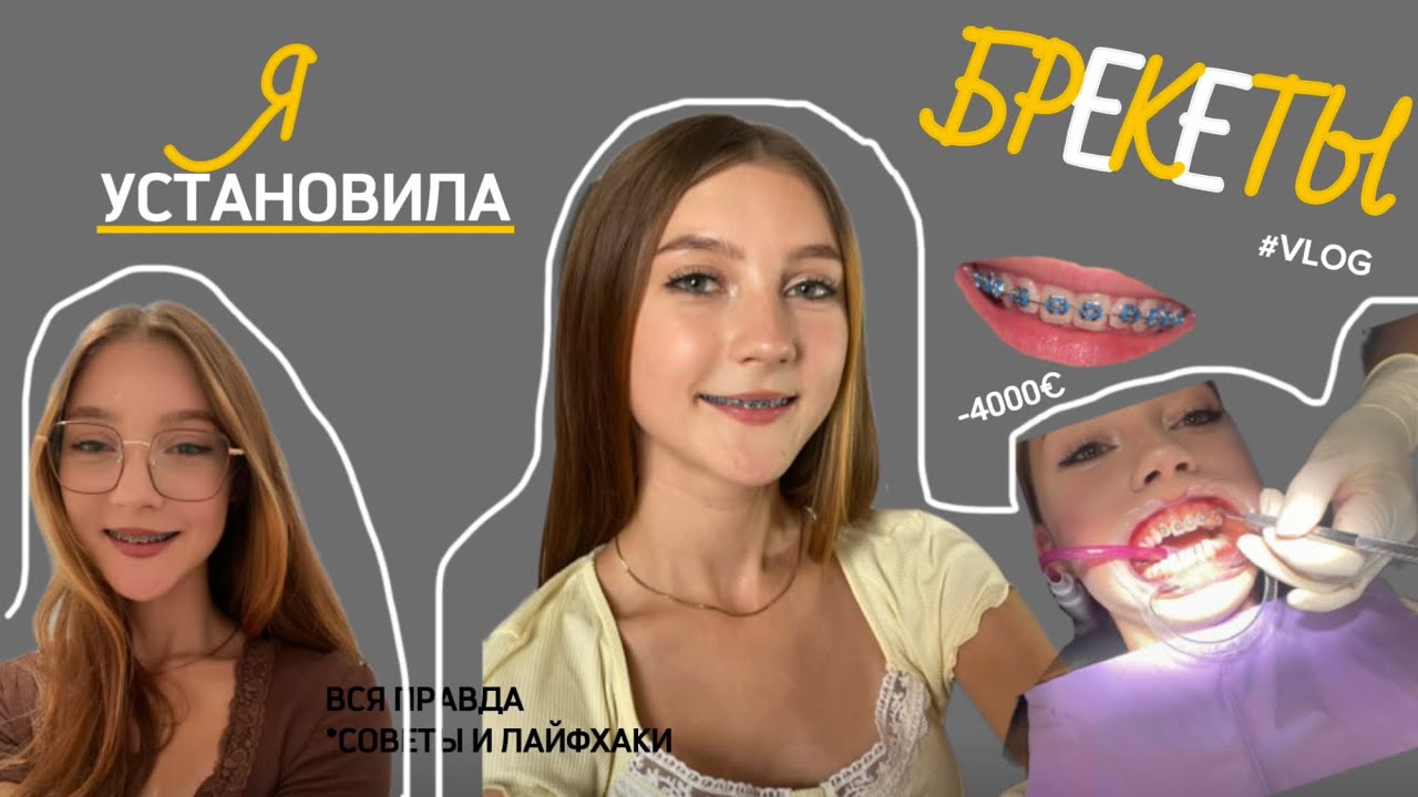 VLOG: Я ПОСТАВИЛА БРЕКЕТЫ!! *первые ощущения* первый месяц с ними….