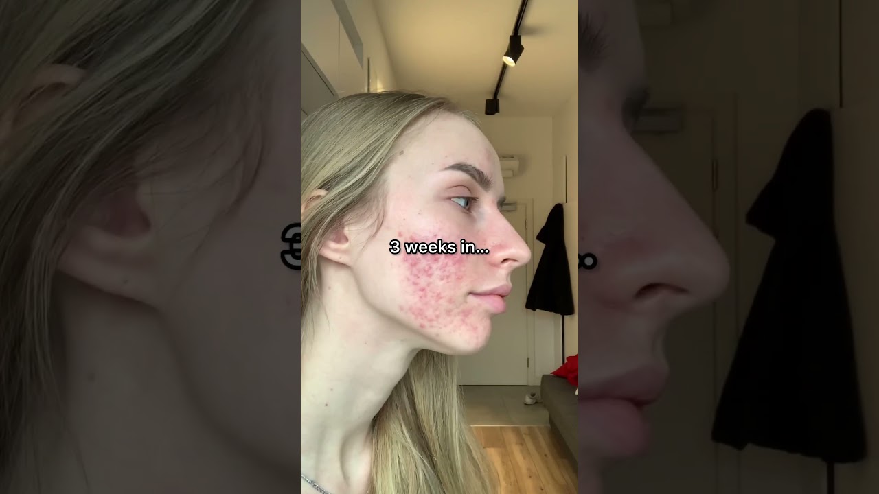 Red light therapy the game for my skin