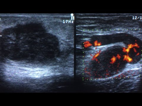 Video: Fibroadenoma - årsager, Symptomer, Diagnose, Behandling, Fjernelse